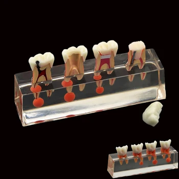 Dentare Model Tratamentul Endodontic Dinți Modelul 4-Etapele De Predare A Studia Demo Dentare Model M4018