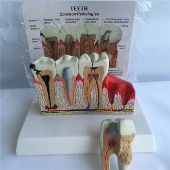 Dinte Uman Frecvente Patologii Anatomie Model Dentare Modelul Medicina Instrument De Predare